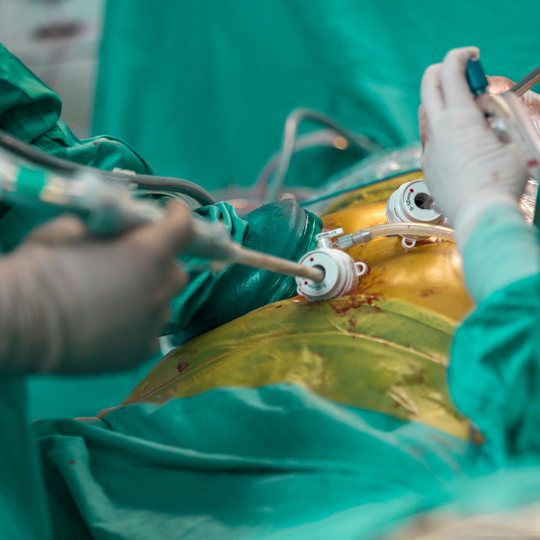 Laparoscopy